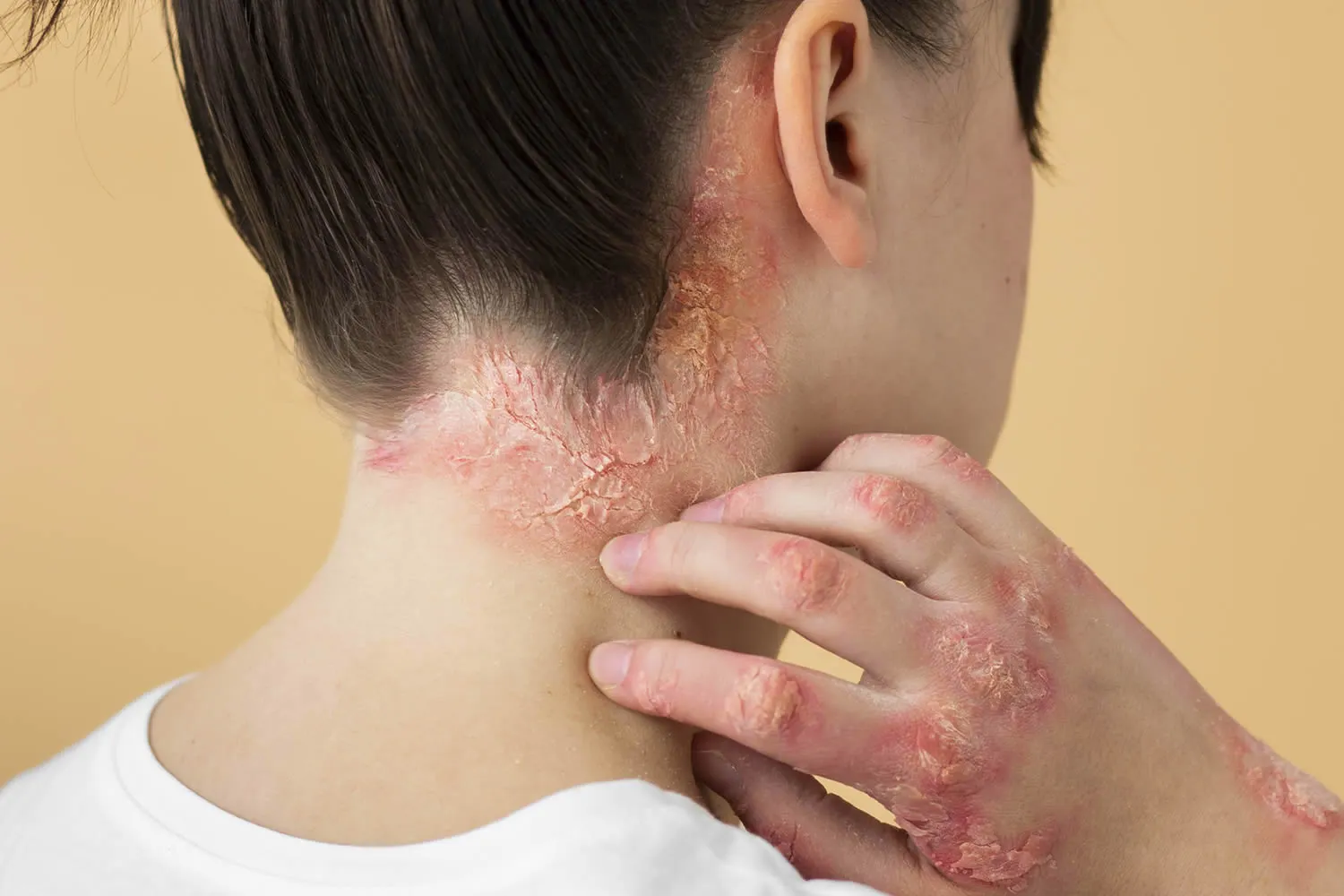 psoriasis-eczema-neck-patient
