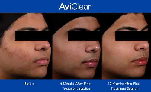AviClear-Before-and-after-treatment-1